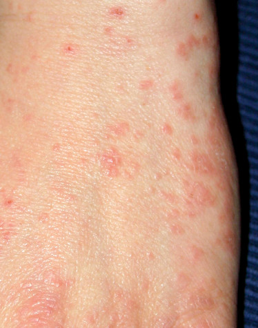 A scabies infection will lead to a skin. rash.